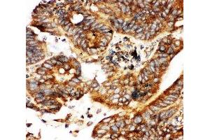 IHC-P testing of human intestinal cancer tissue (CALB1 anticorps  (AA 2-175))
