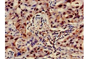 Immunohistochemistry of paraffin-embedded human lung cancer using ABIN7144852 at dilution of 1:100