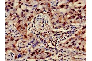 Immunohistochemistry of paraffin-embedded human lung cancer using ABIN7144852 at dilution of 1:100 (ATP5F1D anticorps  (AA 32-158))