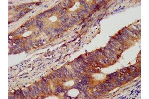 IHC image of ABIN7161261 diluted at 1:400 and staining in paraffin-embedded human colon cancer performed on a Leica BondTM system.