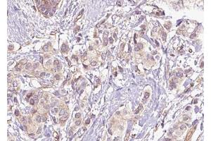 ABIN6267469 at 1/100 staining human breast carcinoma tissue sections by IHC-P. (CDC25C anticorps  (pSer216))