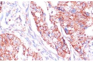 Immunohistochemistry of paraffin-embedded Human colon carcinoma using RPL24 Polyclonal Antibody at dilution of 1:100 (40x lens). (RPL24 anticorps)
