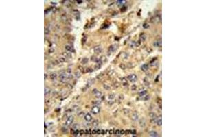 Formalin-fixed and paraffin-embedded human hepatocarcinoma reacted with XDH Antibody (N-term), which was peroxidase-conjugated to the secondary antibody, followed by DAB staining.