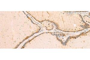 Immunohistochemistry of paraffin-embedded Human thyroid cancer tissue using IP6K3 Polyclonal Antibody at dilution of 1:50(x200) (IP6K3 anticorps)