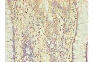 Immunohistochemistry of paraffin-embedded human colon cancer using ABIN7149384 at dilution of 1:100 (AGBL2 anticorps  (AA 10-270))