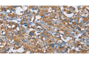 Immunohistochemistry of paraffin-embedded Human thyroid cancer tissue using KLF7 Polyclonal Antibody at dilution 1:40