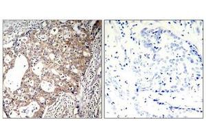Immunohistochemical analysis of paraffin-embedded human breast carcinoma tissue using Shc1(Phospho-Tyr427) Antibody(left) or the same antibody preincubated with blocking peptide(right). (SHC1 anticorps  (pTyr427))