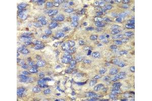 Immunohistochemistry of paraffin-embedded Human liver cancer using SDHA Polyclonal Antibody at dilution of 1:100 (40x lens).