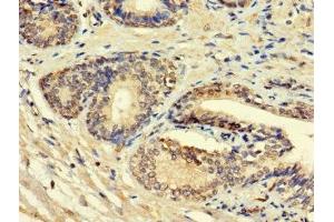 Immunohistochemistry of paraffin-embedded human prostate cancer using ABIN7156008 at dilution of 1:100 (HSD11B1L anticorps  (AA 17-87))