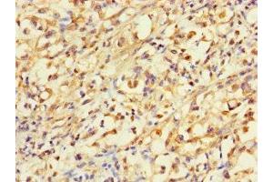 Immunohistochemistry of paraffin-embedded human gastric cancer using ABIN7144946 at dilution of 1:100