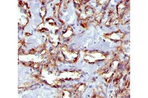 IHC staining of angiosarcoma with PECAM-1 antibody (C31. (CD31 anticorps)
