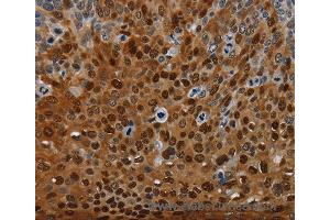 Immunohistochemistry of Human thyroid cancer using NRP2 Polyclonal Antibody at dilution of 1:35 (NRP2 anticorps)