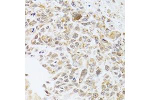 Immunohistochemistry of paraffin-embedded human lung cancer using RNASEL antibody. (RNASEL anticorps  (AA 472-741))
