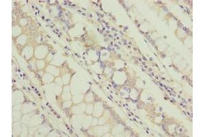 Immunohistochemistry of paraffin-embedded human colon cancer using ABIN7171349 at dilution of 1:100 (TCTA anticorps  (AA 62-103))