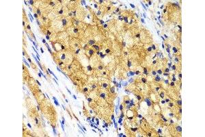 Immunohistochemistry of paraffin-embedded Human lung cancer using CAPG Polyclonal Antibody at dilution of 1:100 (40x lens). (CAPG anticorps)