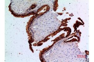Immunohistochemistry (IHC) analysis of paraffin-embedded Human Prostatic Cancer, antibody was diluted at 1:100. (Angiopoietin 1 anticorps  (N-Term))