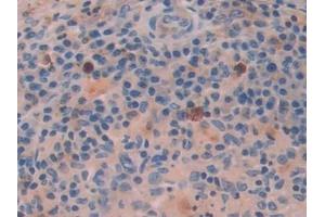 Detection of ATF4 in Human Skin cancer Tissue using Polyclonal Antibody to Activating Transcription Factor 4 (ATF4)