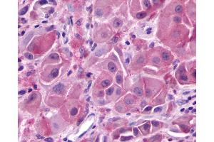 Anti-GPR148 antibody IHC of human Skin, Melanoma.