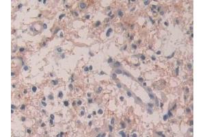 Detection of IL35 in Human Glioma Tissue using Polyclonal Antibody to Interleukin 35 (IL35)