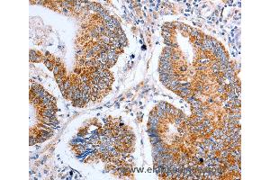 Immunohistochemistry of Human liver cancer using CLDN10 Polyclonal Antibody at dilution of 1:50 (CLDN10 anticorps)