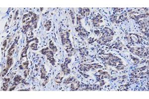 Paraffin embedded sections of human gastric cancer tissue were incubated with RBP4 monoclonal antibody, clone AT2B4 (Cat # MAB3211 ; 1 : 25) for 2 hours at room temperature. (RBP4 anticorps  (AA 19-201))