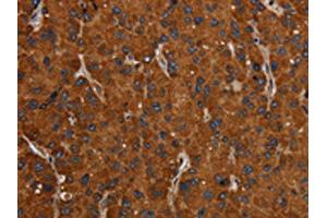 The image on the left is immunohistochemistry of paraffin-embedded Human liver cancer tissue using ABIN7192423(SLC22A12 Antibody) at dilution 1/20, on the right is treated with synthetic peptide. (SLC22A12 anticorps)