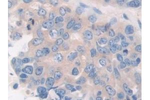 Detection of CaN in Human Breast cancer Tissue using Polyclonal Antibody to Calcineurin (CaN)