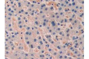 DAB staining on IHC-P; Samples: Human Liver cancer Tissue (TRF1 anticorps  (AA 148-428))