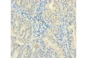 Immunohistochemistry of paraffin-embedded human endometrial cancer using ABIN7176084 at dilution of 1:100