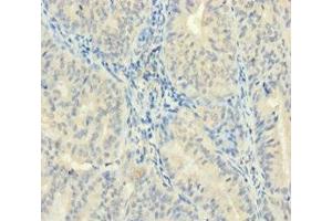 Immunohistochemistry of paraffin-embedded human endometrial cancer using ABIN7176084 at dilution of 1:100 (ZMAT5 anticorps  (AA 1-170))