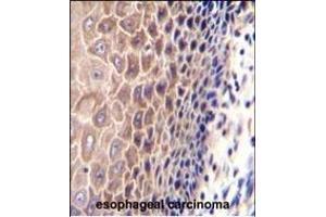 CCDC97 Antibody (C-term) (ABIN655301 and ABIN2844887) immunohistochemistry analysis in formalin fixed and paraffin embedded human esophageal carcinoma followed by peroxidase conjugation of the secondary antibody and DAB staining.