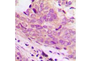 Immunohistochemical analysis of 42064 staining in human prostate cancer formalin fixed paraffin embedded tissue section.
