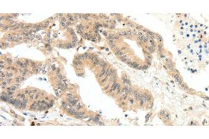 Immunohistochemistry of paraffin-embedded Human colon cancer tissue using RRAD Polyclonal Antibody at dilution 1:50 (RRAD anticorps)