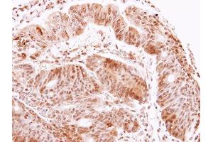 IHC-P Image AChE antibody detects ACHE protein at cytoplasm on human colon carcinoma by immunohistochemical analysis.