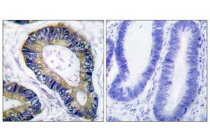 Immunohistochemical analysis of paraffin-embedded human colon carcinoma tissue using 4E-BP1 (epitope around residue 69) antibody (ABIN5976164).