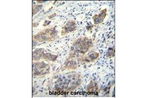 CDH24 Antibody (N-term) (ABIN656094 and ABIN2845437) immunohistochemistry analysis in formalin fixed and paraffin embedded human bladder carcinoma followed by peroxidase conjugation of the secondary antibody and DAB staining. (Cadherin 24 anticorps  (N-Term))