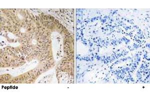 Immunohistochemistry analysis of paraffin-embedded human colon carcinoma tissue using DAP polyclonal antibody . (DAP anticorps)
