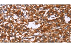 Immunohistochemistry of paraffin-embedded Human thyroid cancer tissue using GPHN Polyclonal Antibody at dilution 1:30 (Gephyrin anticorps)
