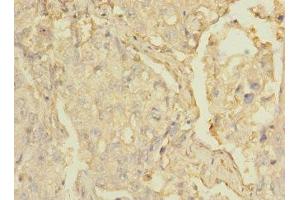 Immunohistochemistry of paraffin-embedded human lung cancer using ABIN7158886 at dilution of 1:100 (MARCO anticorps  (AA 421-520))