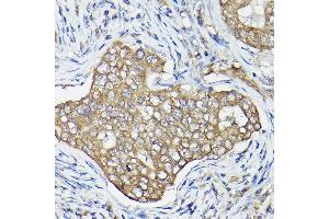 Immunohistochemistry of paraffin-embedded human breast cancer using OL Rabbit pAb (1671) at dilution of 1:100 (40x lens). (OLA1 anticorps  (AA 297-396))
