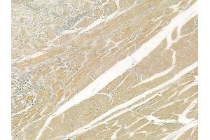 ABIN6262082 and ABIN6276562 at 1/100 staining human tongue carcinoma by IHC-P.