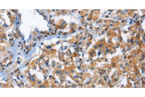 Immunohistochemistry of paraffin-embedded Human thyroid cancer using CD244 Polyclonal Antibody at dilution of 1:50 (2B4 anticorps)