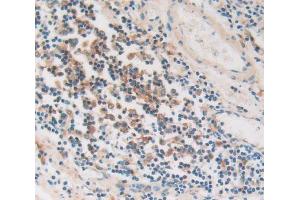 IHC-P analysis of stomach cancer tissue, with DAB staining. (PKIG anticorps  (AA 1-76))