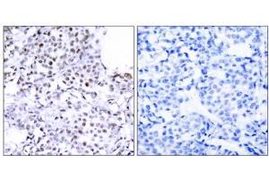 Immunohistochemical analysis of paraffin-embedded human breast carcinoma tissue using SMC1 (Ab-957) antibody (E021190). (SMC1A anticorps)