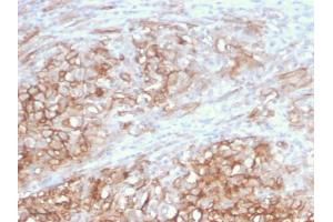 Formalin-fixed, paraffin-embedded human Melanoma stained with MCAM Mouse Monoclonal Antibody (MCAM/3046). (MCAM anticorps  (AA 226-374))