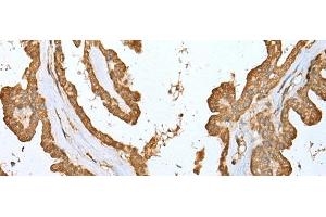 Immunohistochemistry of paraffin-embedded Human thyroid cancer tissue using ALKBH8 Polyclonal Antibody at dilution of 1:25(x200) (ALKBH8 anticorps)