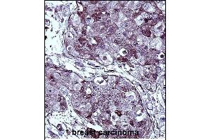 TYSY Antibody (C-term) immunohistochemistry analysis in formalin fixed and paraffin embedded human breast carcinoma followed by peroxidase conjugation of the secondary antibody and DAB staining. (TYMS anticorps  (C-Term))