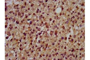 IHC image of ABIN7150649 diluted at 1:200 and staining in paraffin-embedded human glioma performed on a Leica BondTM system. (DSCAM anticorps  (AA 1711-1867))