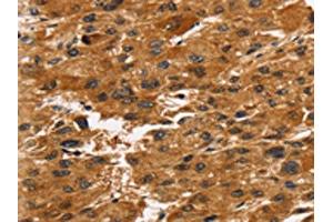 The image on the left is immunohistochemistry of paraffin-embedded Human liver cancer tissue using ABIN7192726(TACC2 Antibody) at dilution 1/30, on the right is treated with synthetic peptide. (TACC2 anticorps)