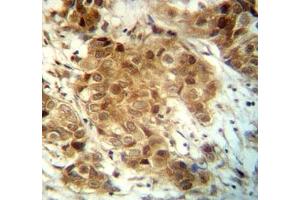 FOXO3 antibody immunohistochemistry analysis in formalin fixed and paraffin embedded human breast carcinoma.